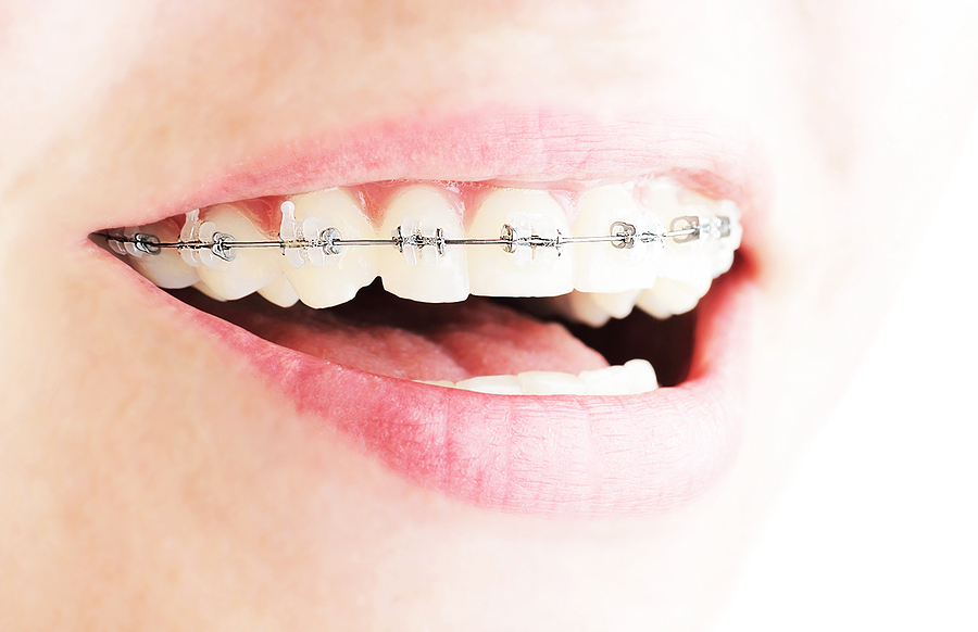 Straight Wire Braces for Straight Teeth