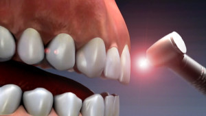 improve-your-dental-experience-thru-laser-surgery