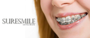 the-sleek-fast-suresmile-dental-braces