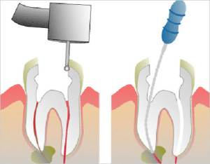 tidbits-of-molar-root-canal2