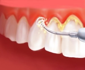 perilous-reactions-of-dental-plaques2