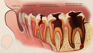 risk-factors-effects-of-tooth-decay