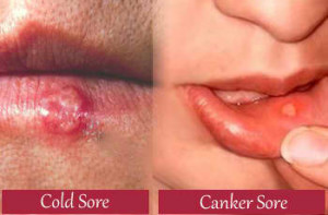 Address Cold & Canker Sores thru Licorice