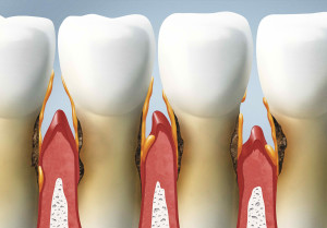 Preventive Ways to Address Root Decay