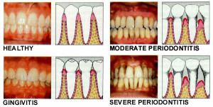 Learn to Spot, Treat & Overcome Periodontal Disease