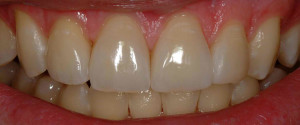 The Risks of Enamel Erosion