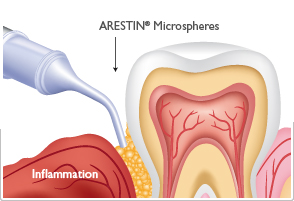 fight-gum-disorder-thru-arestin