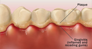 perilous-reactions-of-dental-plaques