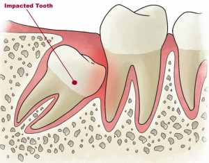 infractions-of-impacted-teeth