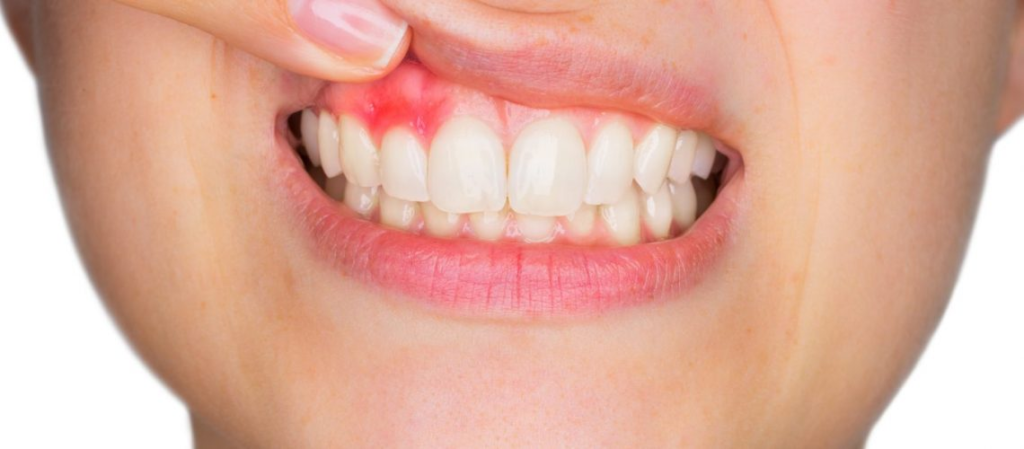 Avoiding Gingivitis thru Home Remedies